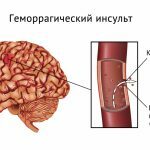 hemoragie accident vascular cerebral