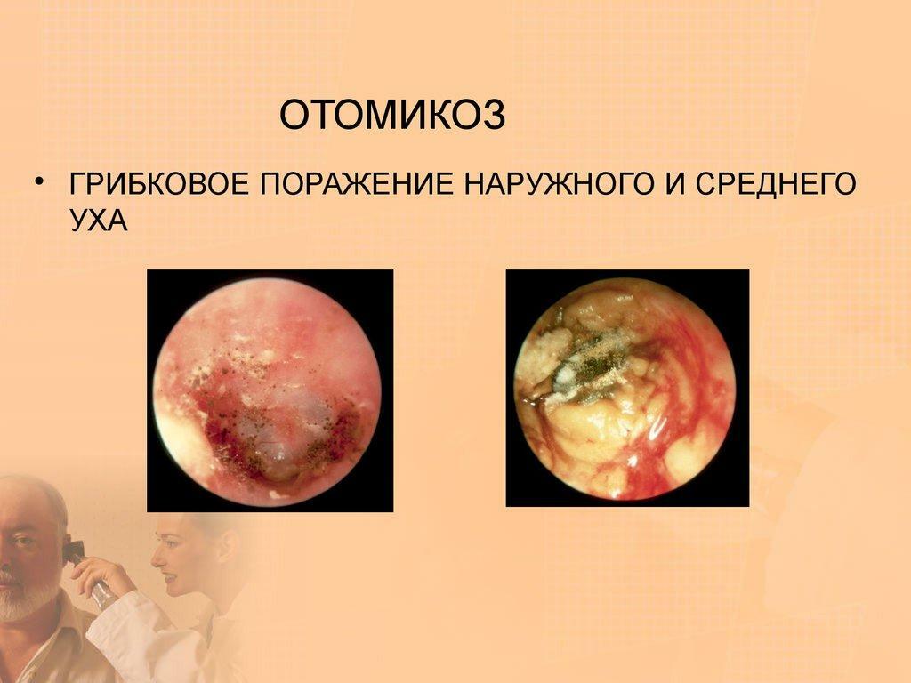 Otomykóza
