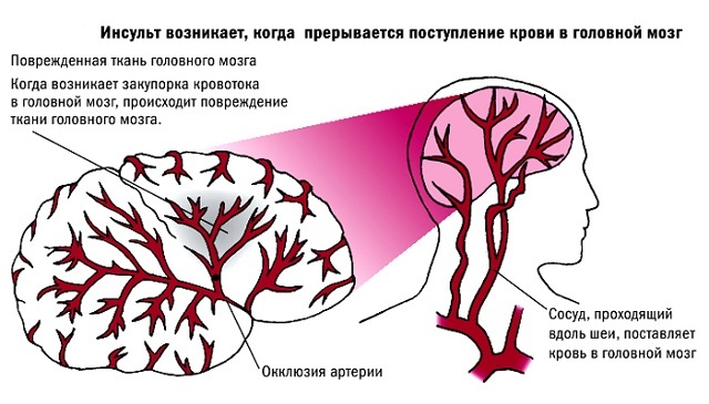 lésions cérébrales