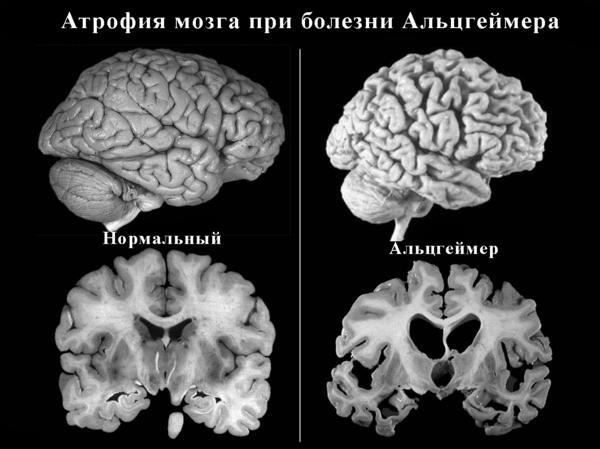 Atrofi af hjernen i tilfælde af sygdom