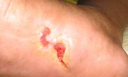 Occurrence of ulcers, photo 2