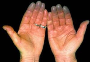 sindromul mâinilor reci