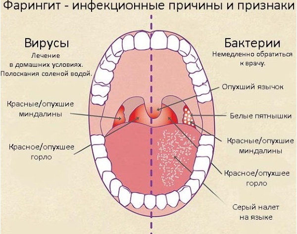 Throat of a healthy person: photo, diseases of the throat and larynx