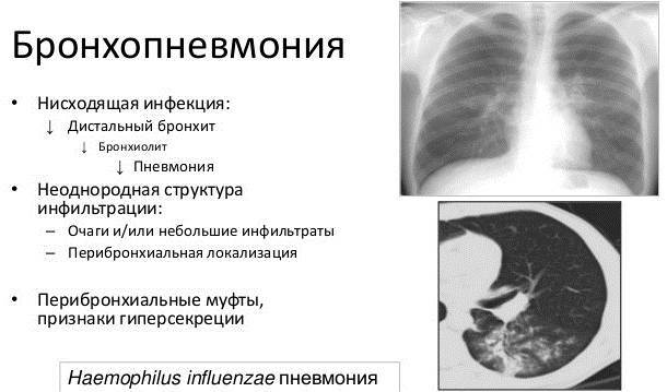 Bronconeumonía en adultos. Síntomas, qué es, tratamiento sin fiebre.