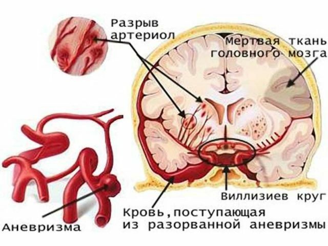 What is the aneurysm of the cerebral vessels and what are the consequences of its rupture