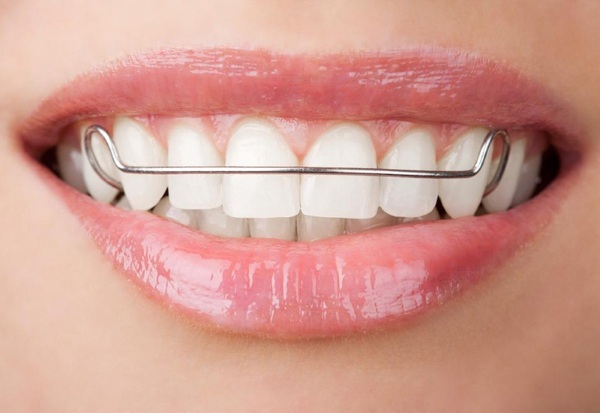 The girl has crooked teeth. Before and after photos, how to fix, methods with and without braces