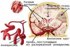 ruptúra ​​aneuryzmy