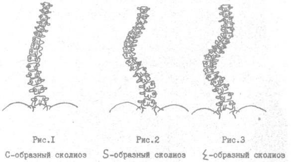 Types of scoliosis of the spine