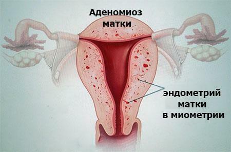 Adenomyosis of the uterus: treatment, drugs