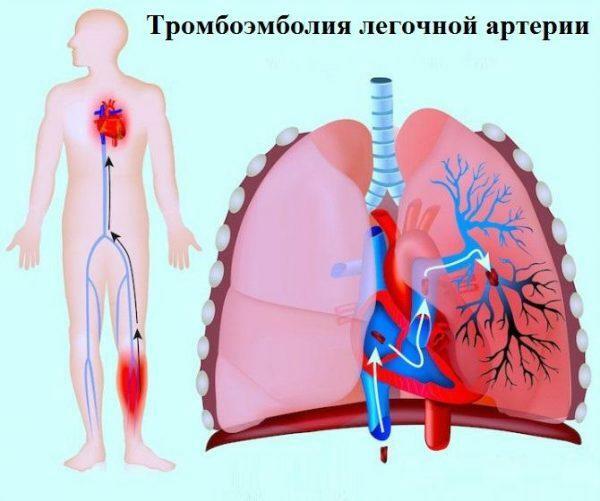 Plaučių arterijos tromboembolija