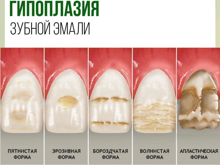 Schwarze Streifen auf den Zähnen des Kindes. Wie zu entfernen