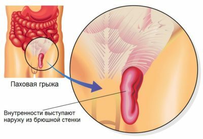 Inguinal and scrotal hernia in men and boys
