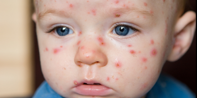 Enterovirus infection in children, adults: signs, symptoms, treatment