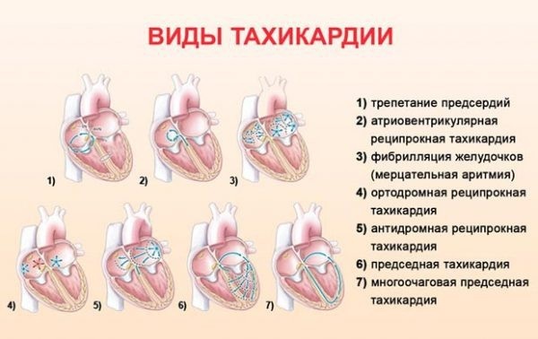 Tachycardia. Symptoms and treatment of paroxysmal, ventricular, supraventricular, sinus. Diagnostics that can not be done