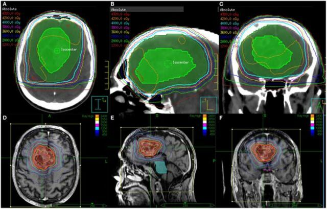Simptomele și tratamentul glioblastomului creierului - cum și de ce oamenii mor dintr-o tumoare, fotografie