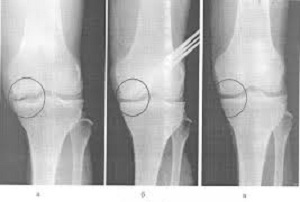 Subchondral sclerosis of articular surfaces and closure plates