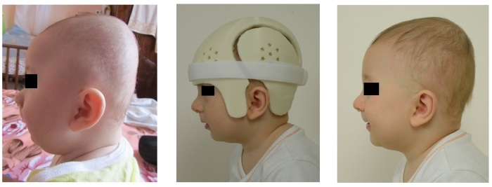 Deformidade do crânio em recém-nascidos, crianças de 3-5-9 meses, com apresentação pélvica. Sinais, sintomas, capacete, como consertar