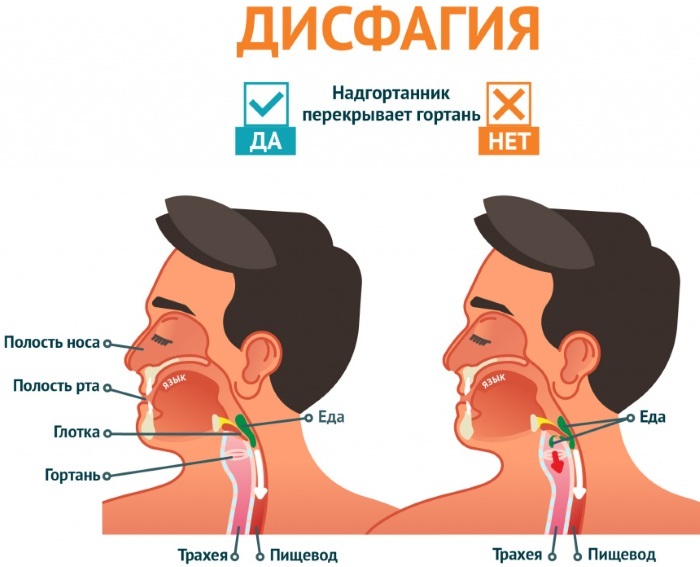 Dysphagia of the esophagus. Symptoms and treatment, what is it, causes