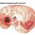 subarahnoidni moždani udar