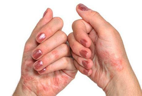 In the photo, skin lesions of psoriasis and polyarthritis