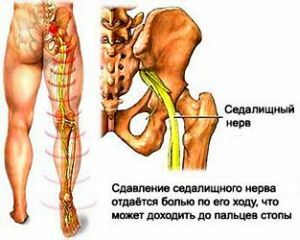 smerte i den pæreformede muskel