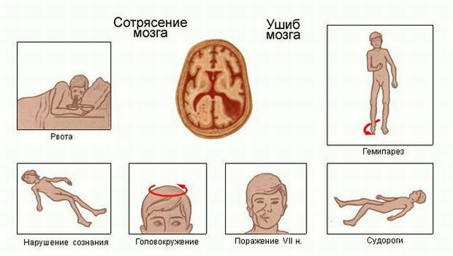 concussion and bruise of the brain