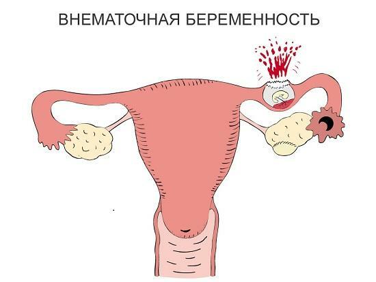 Fallopian vamzdžio plyšimas negimdiniame nėštumyje