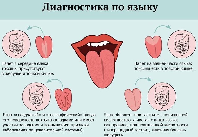 Bruine plaque op de tong bij volwassenen, kinderen. De redenen die dit kan betekenen, hoe te verwijderen, zich te ontdoen van