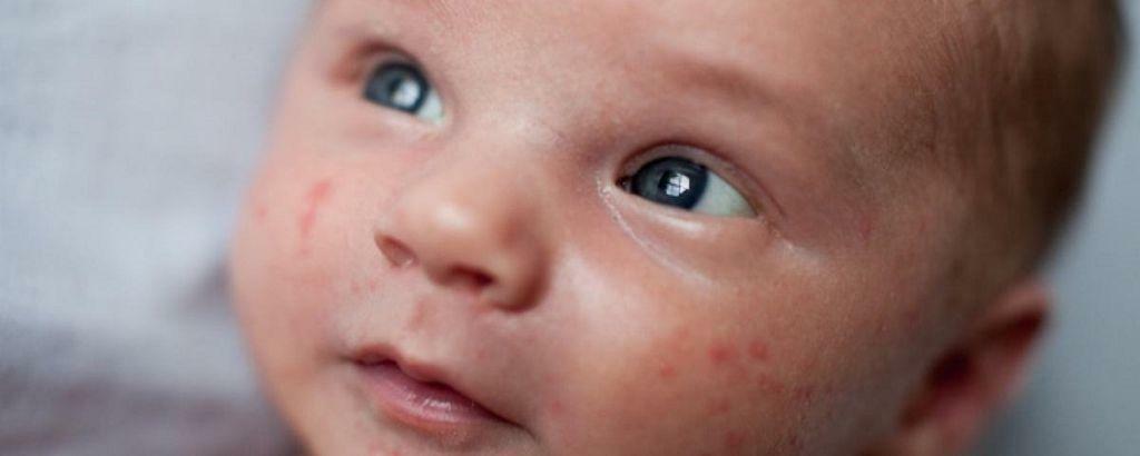 Doenças da infância com erupção cutânea na pele - doenças, causas, sintomas e tratamento