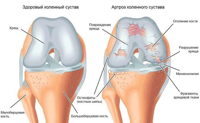 Injections into the knee joint with osteoarthritis. Formulations Hyaluronic acid