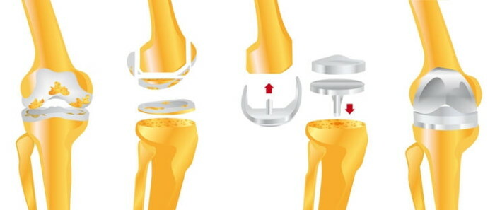 Artroplastika kolena. Cena, sanacija