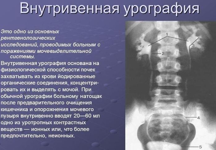 Excretory urography. Preparation of the patient, what is it, how is it carried out, contraindications