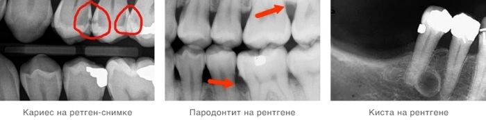Røntgen af ​​tænder. Panoramabillede, som det gøres under graviditeten, hvilket viser prisen