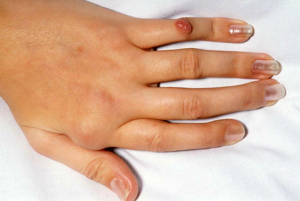 Fingers deformed with arthrosis
