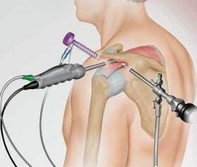 Arthroscopy of the shoulder joint