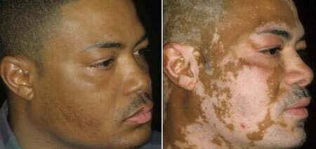 Behandlung von Vitiligo