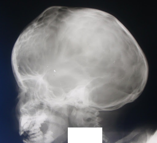 Craniostenose (craniosynostose) bij kinderen en volwassenen. Wat is het, symptomen, klinische richtlijnen?