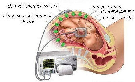 Hypertonisitet i livmoren under graviditet 1-2-3 trimester. Behandling