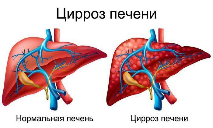Diffuse changes in the liver parenchyma and pancreatic cancer. What it is, treatment
