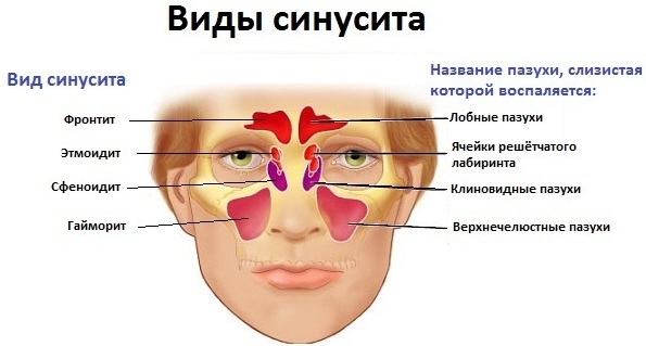 Sinusitis in children. Symptoms and treatment of folk remedies, antibiotics, the most effective drugs. Signs of chronic, suppurative, how to determine quickly cure at home