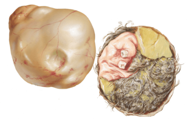 Teratoma with hair