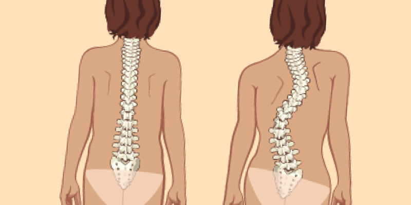 the fourth degree of scoliosis