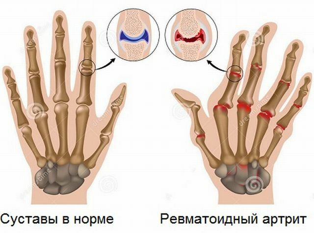 Simptomele artritei reumatoide