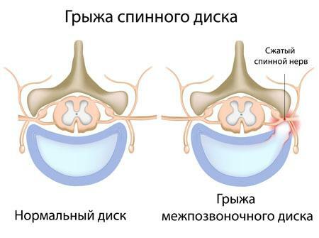 Differences in the normal disc and intervertebral disc with hernia