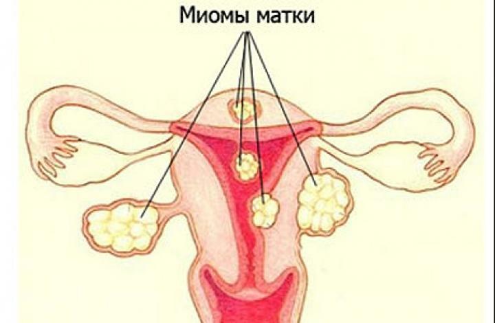 Symptome von Uterusmyomen: wie man erkennt