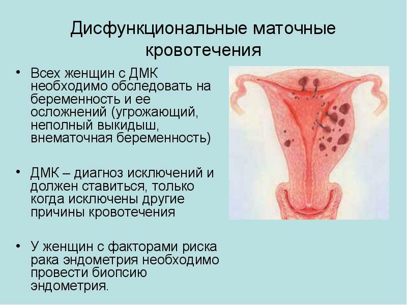 Dysfunkčné maternicové krvácanie