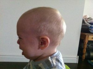 copil cu anomalie craniană