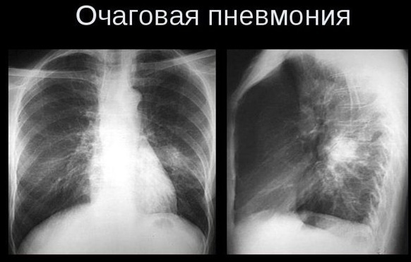 Radiografia OGK. Ce este în 2 proiecții, proiecție directă, pregătire, decodare, preț