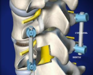 immobilization of the vertebrae