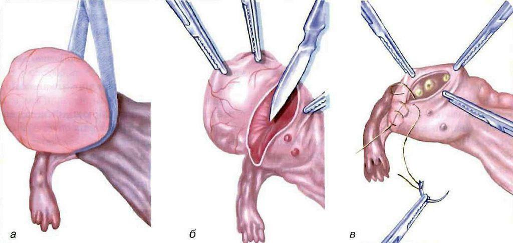 Resección vesicular del ovario